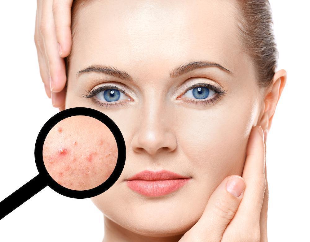 Acne Can Be Reduced With Isotroin 20mg