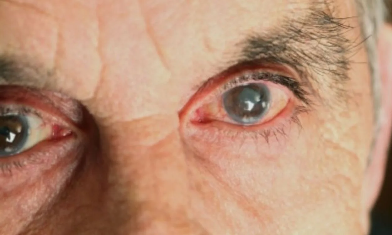 Diabetic Macular Edema Market