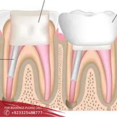 Save Your Smile with Expert Root Canal Treatment in Islamabad