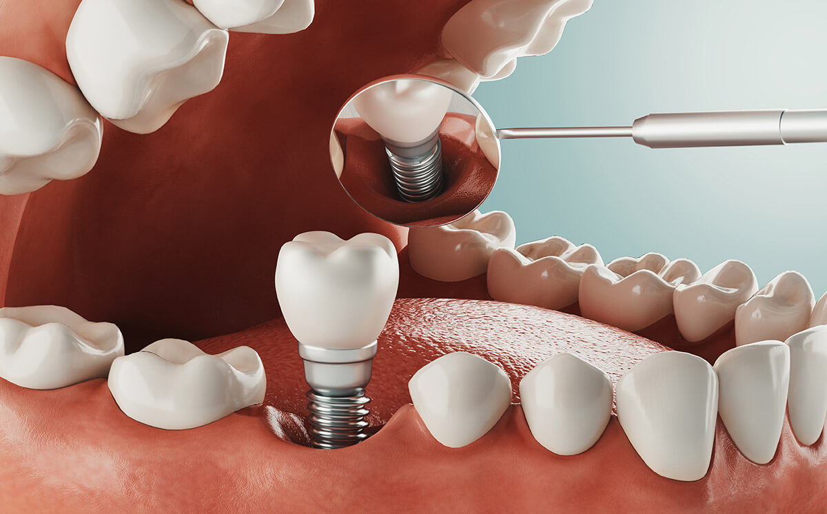 affordable dental implants