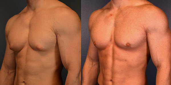 Gynecomastia Surgery: How to Prepare Your Home for Recovery