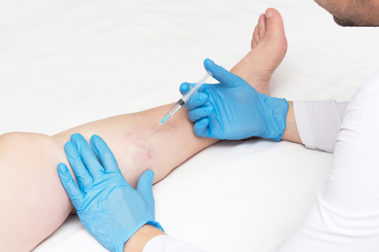 Sclerotherapy