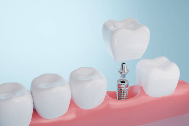 Replace Missing Teeth: Dental Implants Options and Benefits