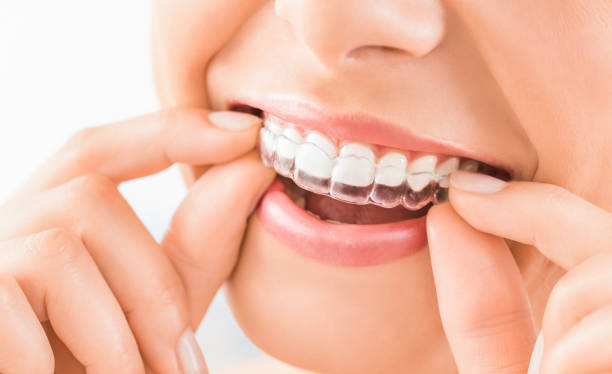 Discover the Power of Invisalign Clear Braces in Pakistan