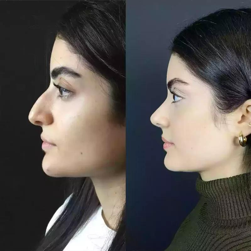 Why Choose the Best Rhinoplasty Surgeons in Dubai?