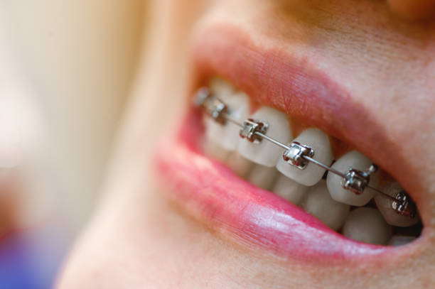 Lingual Braces vs. Clear Aligners