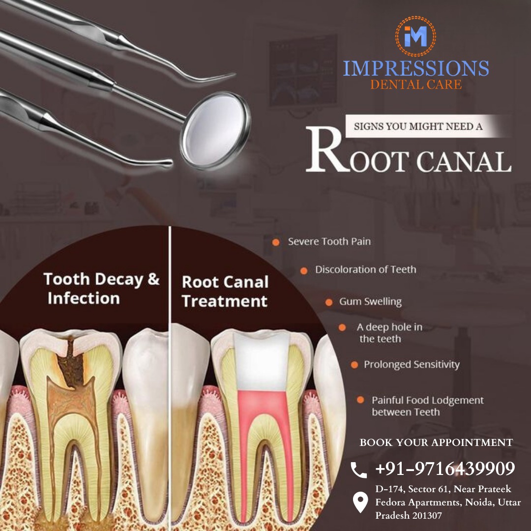 Best root canal treatment in Noida at Impressions Dental Care