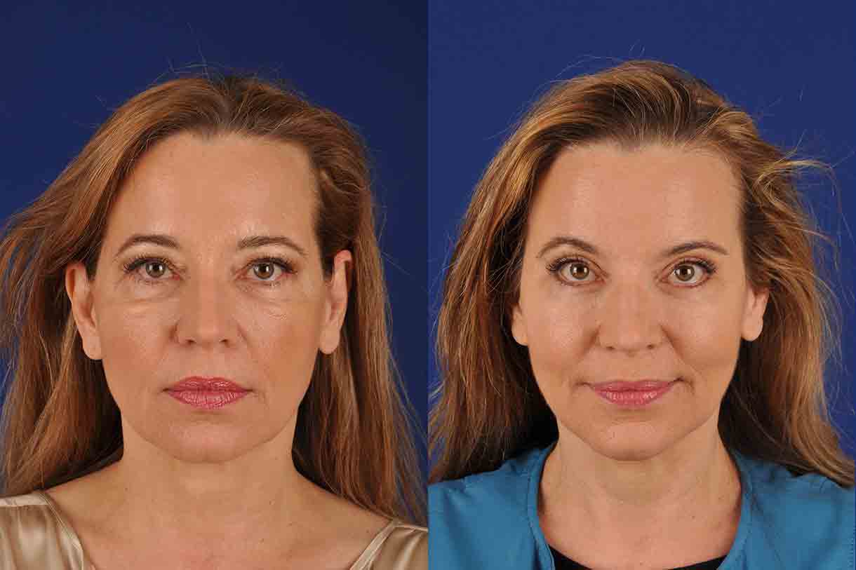 Transform Your Appearance with a Brow Lift in San Diego